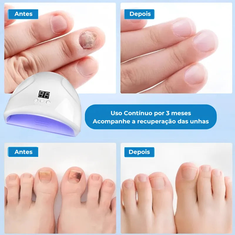 Dispositivo Laser Funcional Para Unhas